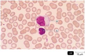 Large lymphocyte with unusual lobed nucleus in mononucleosis