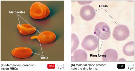 Malaria: Merozoites inside RBCs and ring forms in blood smear