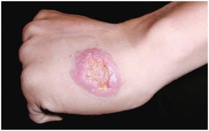 Cutaneous leishmaniasis