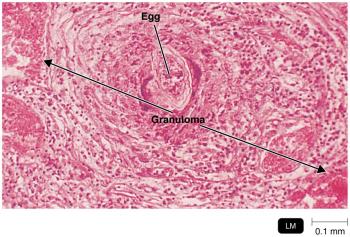 Granuloma from a patient with schistosomes