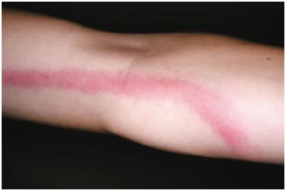 Lymphangitis, a sign of sepsis