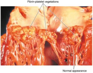 Bacterial endocarditis with fibrin-platelet vegetations