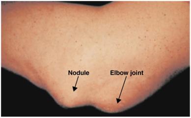 Nodule caused by rheumatic fever
