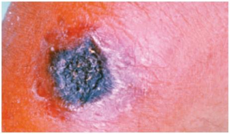 Anthrax lesion