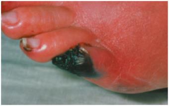 Gangrene affecting the toes