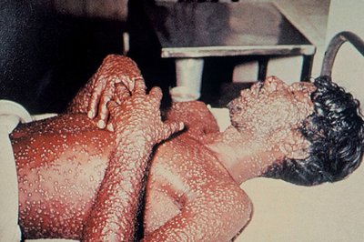 Smallpox maculopapular rash and blisters