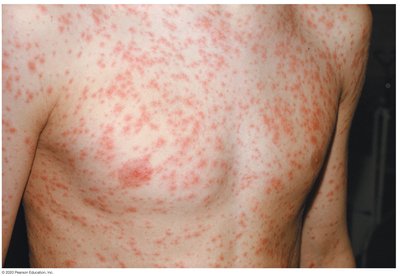 Rubella rash on torso