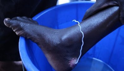 Guinea worm eradication