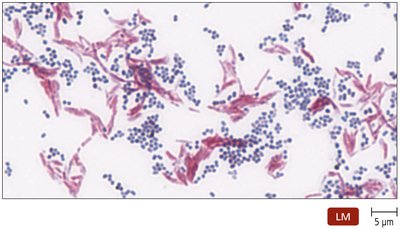 Acid-fast stain showing red and blue bacteria