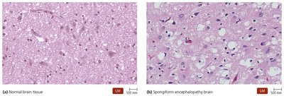 Normal vs spongiform encephalopathy brain tissue