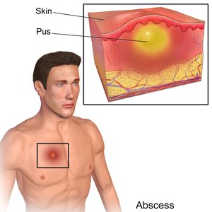 Abscess formation in soft tissue