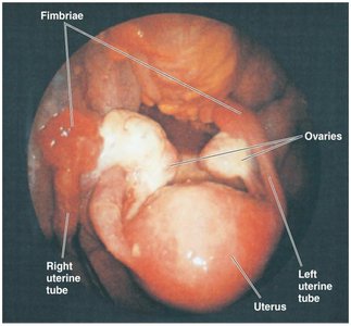 Salpingitis (PID)