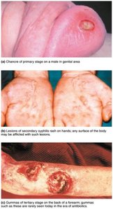 Lesions of various stages of syphilis