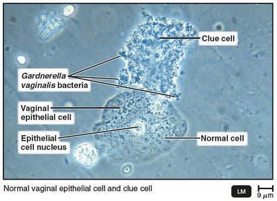 Clue cell in bacterial vaginosis