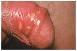 Vesicles of genital herpes on a penis