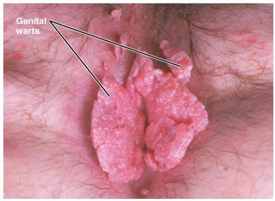 Genital warts on a vulva