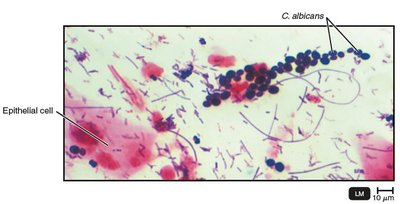 Gram-stained smear of vaginal discharge with C. albicans