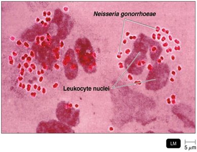 Smear of pus showing Neisseria gonorrhoeae