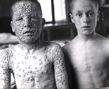 Children with smallpox lesions, illustrating the impact of vaccination