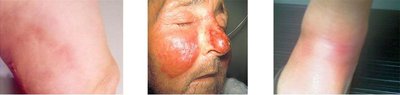 S. pyogenes skin infections: cellulitis, erysipelas, erythema nodosum