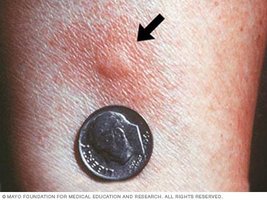 Positive reaction to skin test