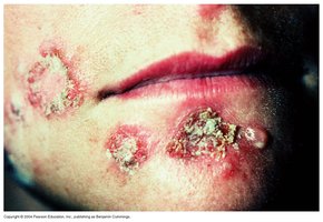 Erysipelas and impetigo lesions on the face