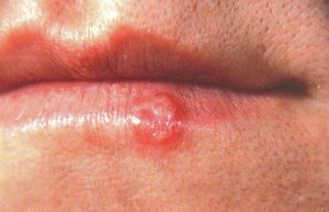 Cold sore on the lip caused by herpes simplex virus
