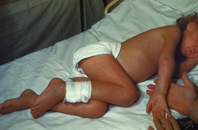 Child with RMSF rash