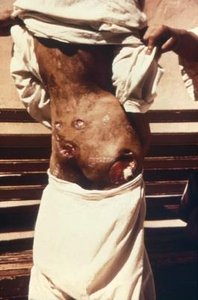 Severe skin lesions in epidemic typhus
