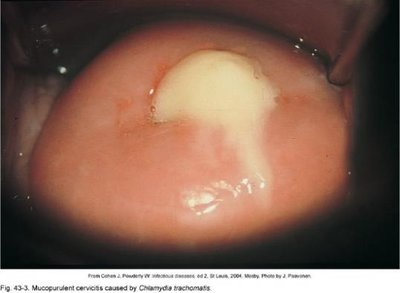 Mucopurulent cervicitis caused by Chlamydia trachomatis