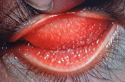 Conjunctival inflammation in trachoma