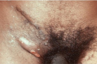 Lymphogranuloma venereum with inguinal buboes