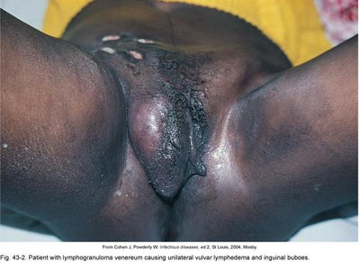 Severe vulvar lymphedema in LGV