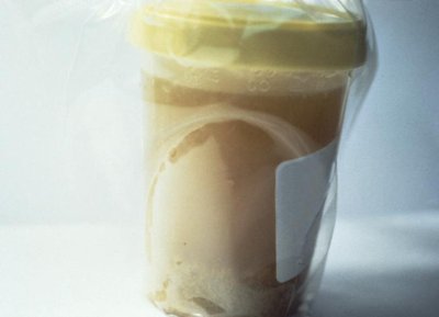 Rice water stool sample, characteristic of cholera