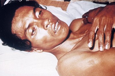 Severe dehydration in cholera patient