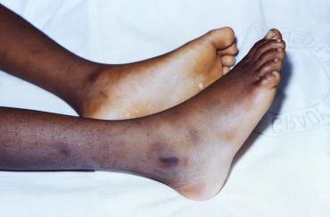 Petechial rash on lower extremities in RMSF