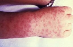 Rash on hand in RMSF