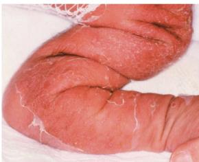 Staphylococcal scalded skin syndrome in an infant