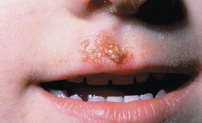 Impetigo on the face of a child