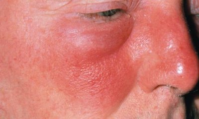 Erysipelas on the face
