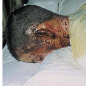Pathogenesis of Rocky Mountain spotted fever