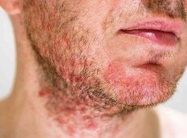 Folliculitis on the face