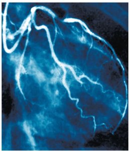 Blocked coronary artery