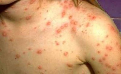 Petechial rash on skin (RMSF)
