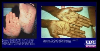 Syphilitic rash on palms and soles (secondary syphilis)