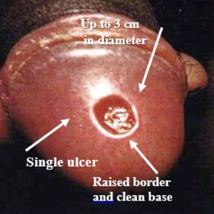 Chancre in a female (primary syphilis)