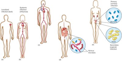 Diagram showing localized, systemic, focal, and mixed infections