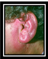 Otitis externa (outer ear infection)