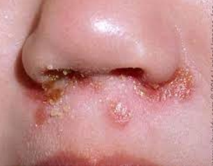 Impetigo with yellow scabs