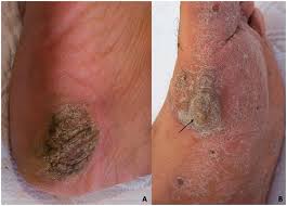 Toenail infection (onychomycosis)